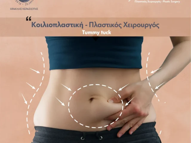 Κοιλιοπλαστική