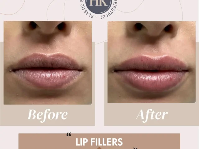 Lip Fillers