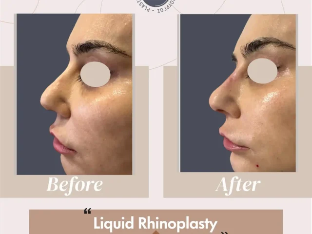 Liquid Rhinoplasty