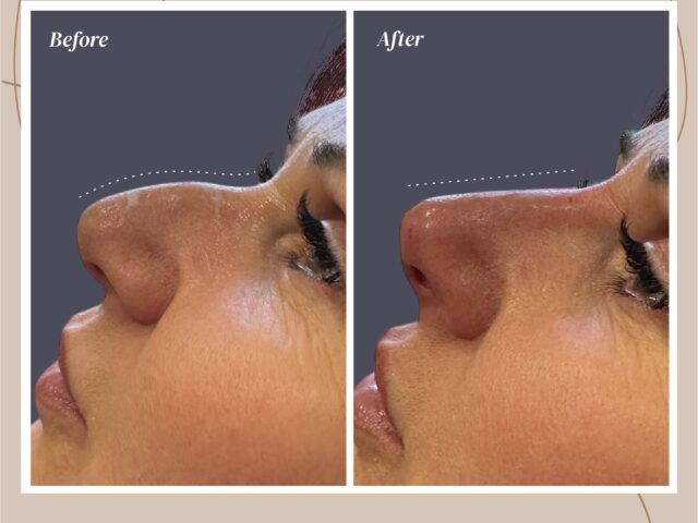 KERASIOTIS IRAKLIS – Πλαστικός Χειρουργός / Liquid Rhinoplasty